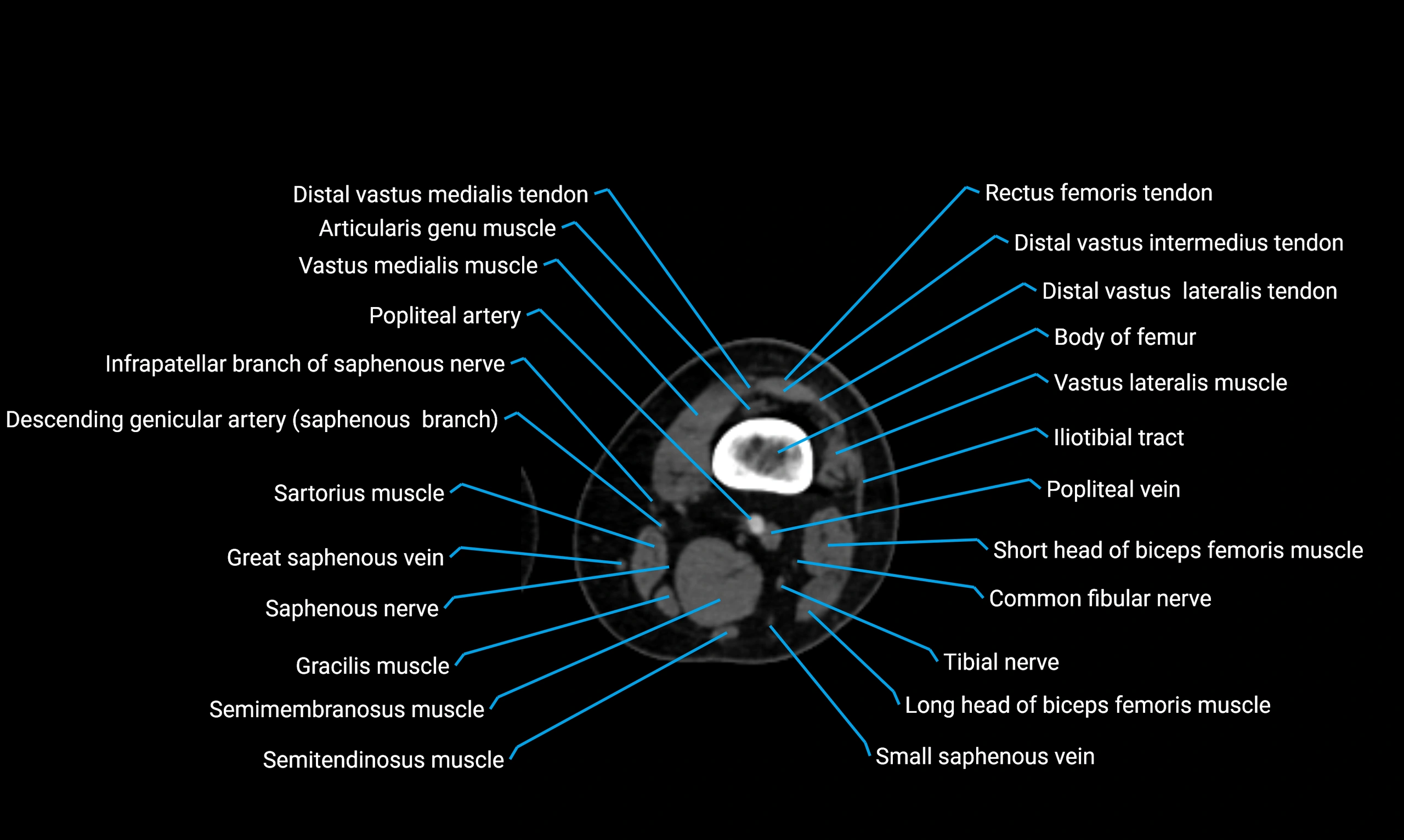 CT lower limb axial cross sectional anatomy labelled image 76 (2).webp